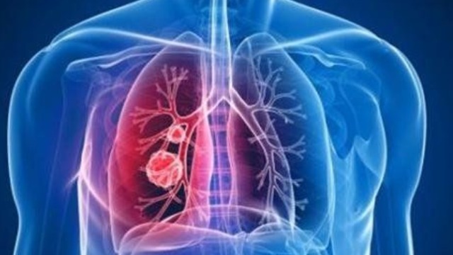 铁岭肺炎最新动态,科技之光助力防护之路