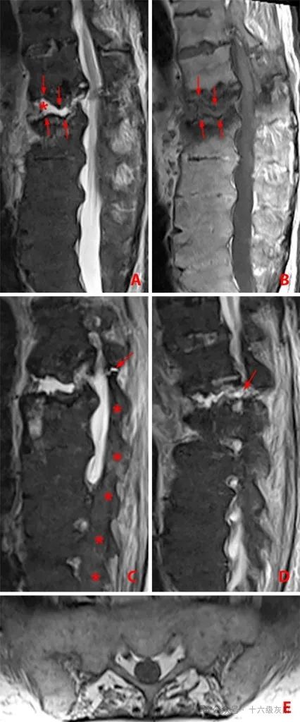 强直性脊柱炎国际最新研究进展概览
