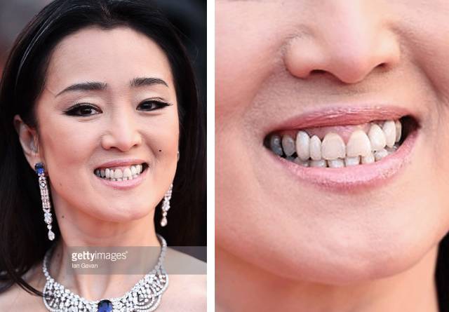 演员假牙安装与佩戴指南,从选择到佩戴的步骤全解析