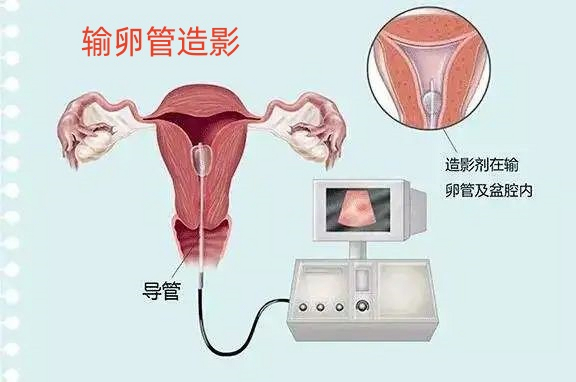 输卵管通液之旅,价格与爱的陪伴的奇妙经历