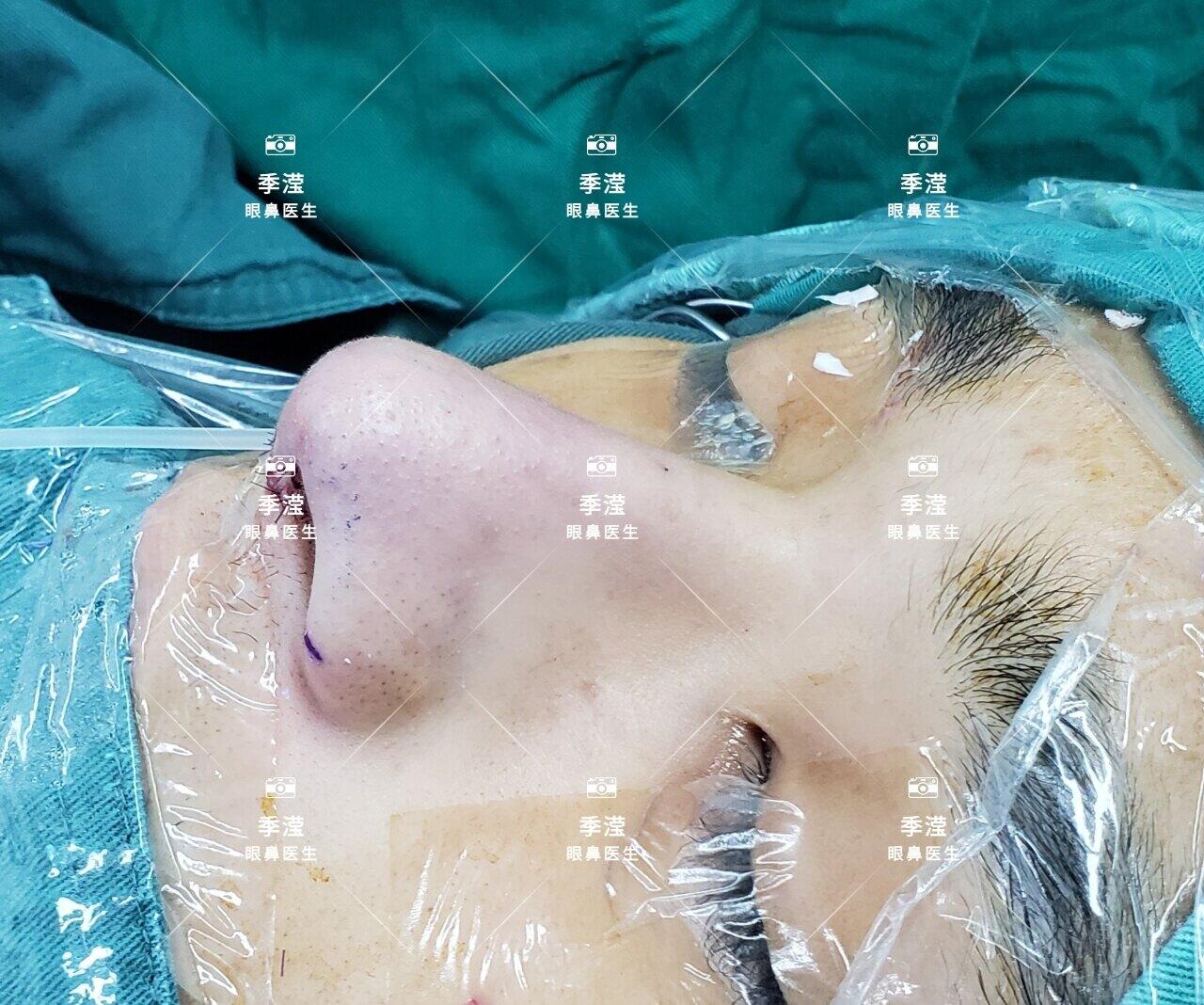 干细胞鼻甲再生研究最新进展,揭秘再生医学新时代突破!