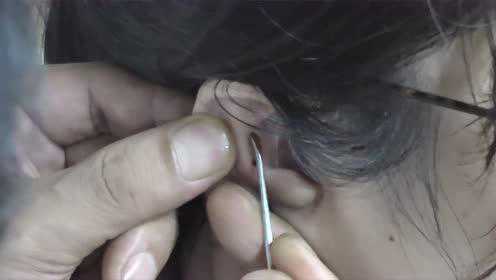 赵医生掏耳朵教学视频,轻松学习耳朵清洁的正确方法