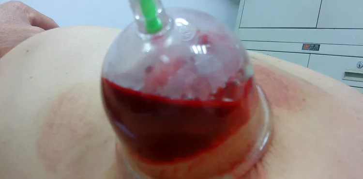 最新疱疹治疗方法详解，步骤指南与操作建议