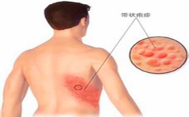 最新疱疹治疗方法详解,步骤指南与操作建议