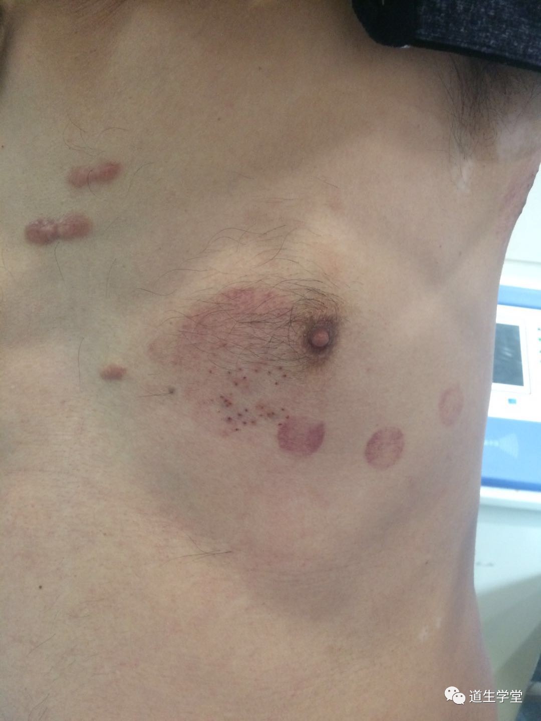 最新疱疹治疗方法详解,步骤指南与操作建议