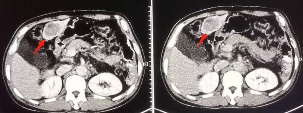 晚期肝癌最新疗法,科技之光引领生命新生之路