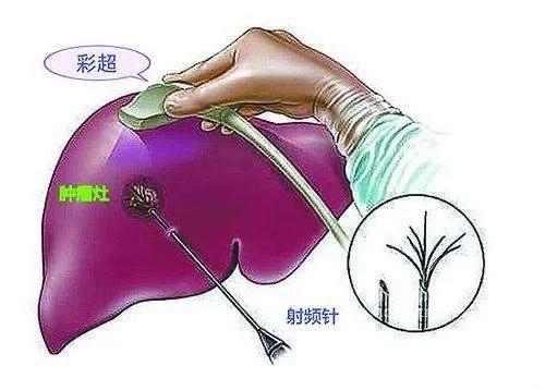 晚期肝癌最新疗法,科技之光引领生命新生之路